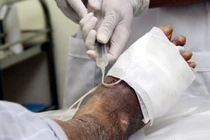 Nhận biết viêm tắc động mạch chi