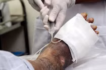 Nhận biết viêm tắc động mạch chi