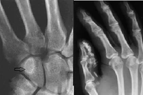 Bị bệnh u xương sụn có nguy hiểm không?