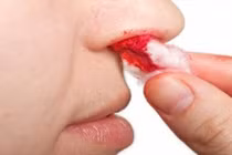 Dấu hiệu ung thư máu bạn có thể nhận ra