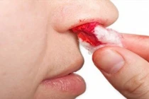 Dấu hiệu ung thư máu bạn có thể nhận ra