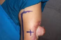 Giúp bạn nhận biết bệnh ung thư tuyến mồ hôi 