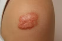 Vết sẹo lâu ngày có thể dẫn đến ung thư 