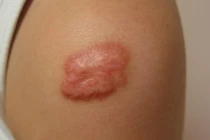 Vết sẹo lâu ngày có thể dẫn đến ung thư 