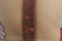 Suýt tàn phế vì đắp lá chữa đau lưng