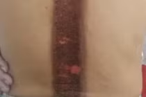 Suýt tàn phế vì đắp lá chữa đau lưng