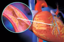 Cách uống trà, ăn rau ngừa bệnh mạch vành