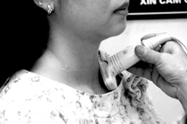 Lý do không nên chủ quan với bệnh bướu cổ 