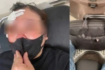 Nguyên nhân vụ người phụ nữ đi xe máy bị đánh vào đầu