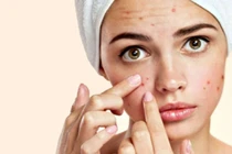 Giải pháp toàn diện đối phó với mụn trứng cá trong chu kỳ kinh nguyệt