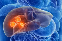 Soi bất thường trên mặt, nhận diện ung thư gan sớm nhất