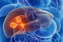 Soi bất thường trên mặt, nhận diện ung thư gan sớm nhất