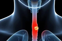 4 kiểu ăn phổ biến, sớm muộn gây ung thư thực quản