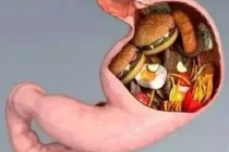 Thực phẩm “bức tử” dạ dày, vạn người ăn hàng ngày không biết