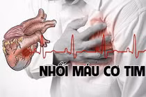 Loạt dấu hiệu nhận biết nhanh của nhồi máu cơ tim