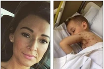 Biến chứng nhiễm trùng máu thủy đậu do dùng sai thuốc