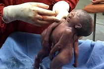 Rớt nước mắt nhìn cặp song sinh chung đầu qua đời