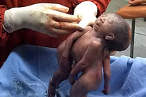 Rớt nước mắt nhìn cặp song sinh chung đầu qua đời