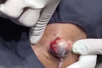 Khủng khiếp màn nặn mụn to như quả trứng gà