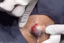 Khủng khiếp màn nặn mụn to như quả trứng gà