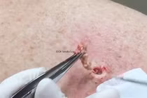 Kinh khủng khiếp màn nặn mụn dài như giun