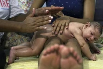 Brazil xác nhận gần 5.000 ca mắc tật đầu nhỏ