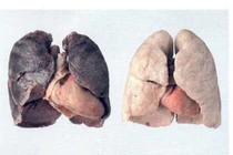 Tác động khủng khiếp của ô nhiễm không khí đến sức khỏe