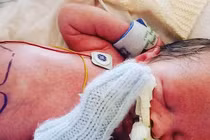 Thương tâm bé trai có ruột nằm ngoài cơ thể