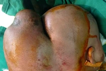 Bé 5 tháng tuổi có “hai đầu” do u nang khổng lồ