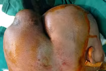 Bé 5 tháng tuổi có “hai đầu” do u nang khổng lồ