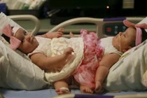 Tách thành công cặp song sinh dính liền hiếm gặp