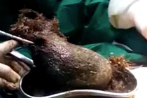 Rợn người búi tóc nặng hơn 1kg trong bụng cô gái 17 tuổi