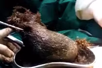 Rợn người búi tóc nặng hơn 1kg trong bụng cô gái 17 tuổi