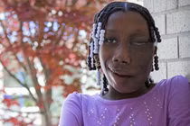 Cuộc đời bi kịch của cô gái mang khối u ác nghiệt