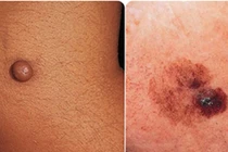 Phân biệt u ác tính với khối u thông thường