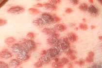 Cách dễ dàng phát hiện ung thư da tại nhà