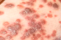 Cách dễ dàng phát hiện ung thư da tại nhà