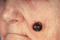 Phát hiện ung thư da từ nốt ruồi đáng ngờ
