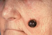 Phát hiện ung thư da từ nốt ruồi đáng ngờ