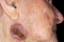 Những dấu hiệu ung thư da thường thấy trên mặt