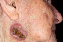 Những dấu hiệu ung thư da thường thấy trên mặt