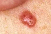 Những điều ít biết về ung thư da