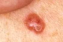 Những điều ít biết về ung thư da