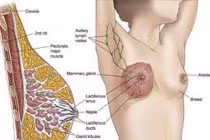 Phân loại các dạng ung thư vú thường gặp