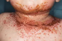 Ngừa được ung thư da nhờ có eczema?