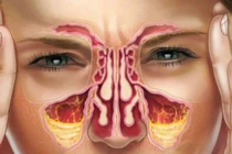 8 biện pháp giúp F0 giảm ngạt mũi, tránh khô họng, đau họng