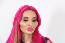 Nàng mẫu có "gò má cao nhất thế giới" tiêm filter suốt 4 năm