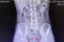 Nghịch dại vì muốn tạo khoái cảm, nam thanh niên phải nhập viện