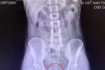 Nghịch dại vì muốn tạo khoái cảm, nam thanh niên phải nhập viện