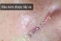 Gãy kim khi đang tiêm filler xóa rãnh mũi má ở tiệm tóc